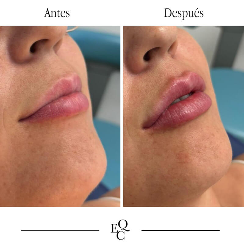 antes y despues aumento labios malaga