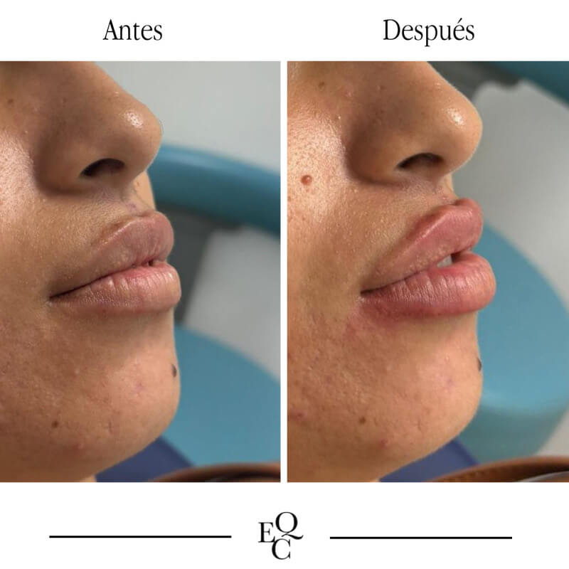 aumento de labios dentista malaga