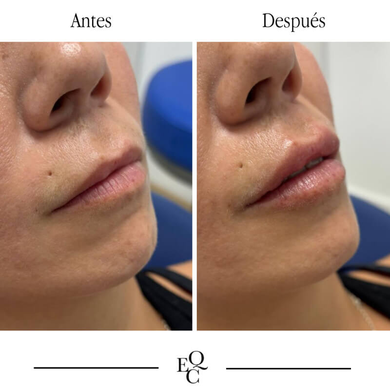 antes y despues en aumento de labios en malaga dentista