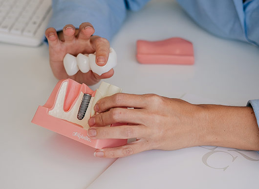 dientes fijos 24h malaga