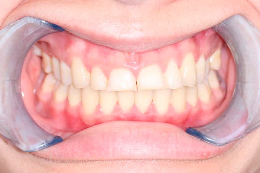 antes despues carillas dentales malaga 1