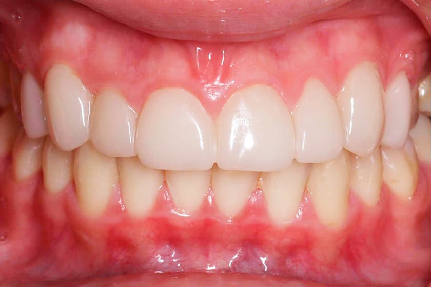 antes despues carillas dentales malaga 2