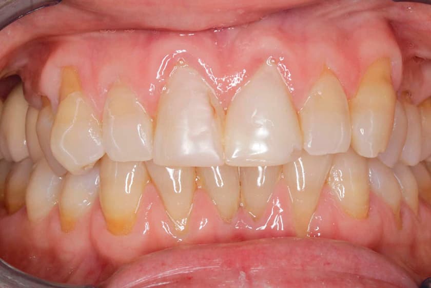 antes despues carillas dentales malaga 3