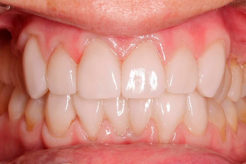 antes despues carillas dentales malaga 4