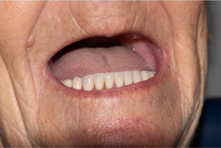 antes despues dientes fijos 24h malaga 1