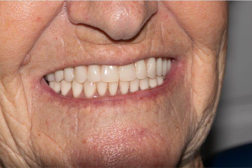 antes despues dientes fijos 24h malaga 2
