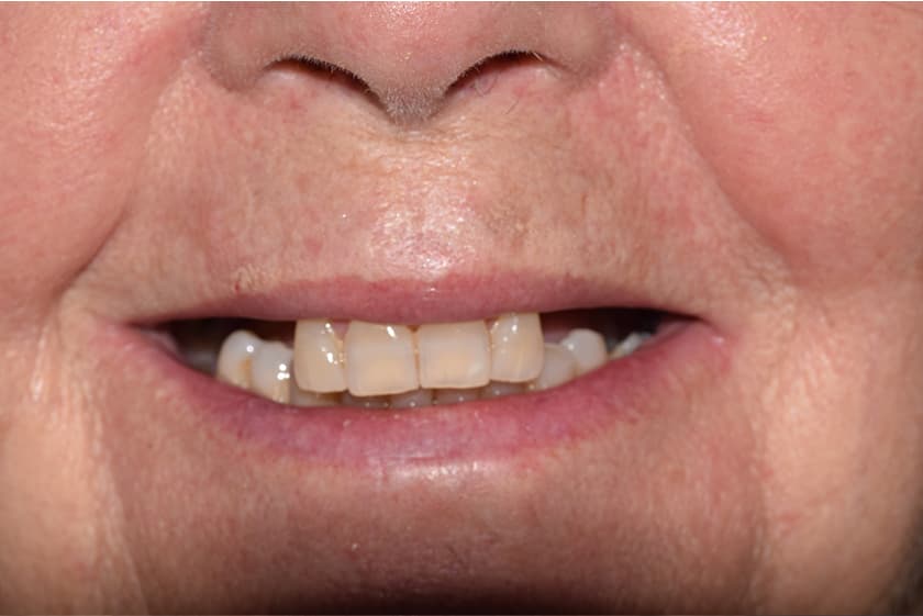 antes despues implantes dentales malaga 1