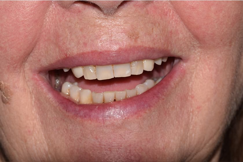 antes despues implantes dentales malaga 2